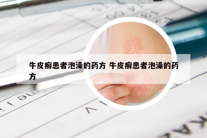 牛皮癣患者泡澡的药方 牛皮癣患者泡澡的药方