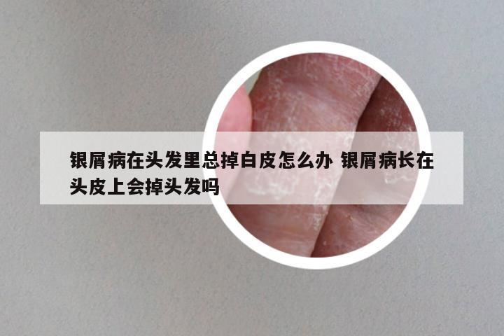 银屑病在头发里总掉白皮怎么办 银屑病长在头皮上会掉头发吗