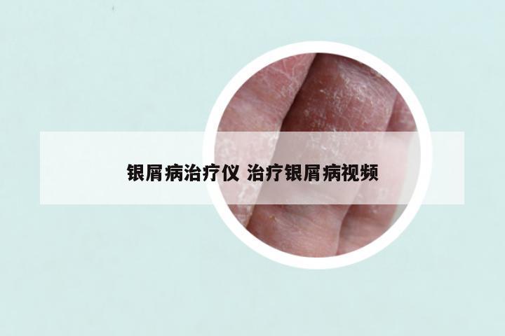 银屑病治疗仪 治疗银屑病视频
