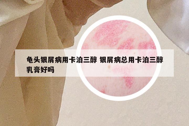 龟头银屑病用卡泊三醇 银屑病总用卡泊三醇乳膏好吗