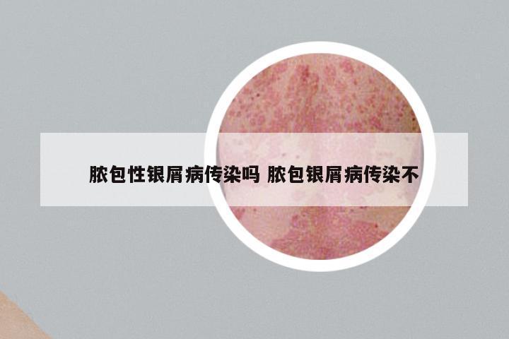 脓包性银屑病传染吗 脓包银屑病传染不