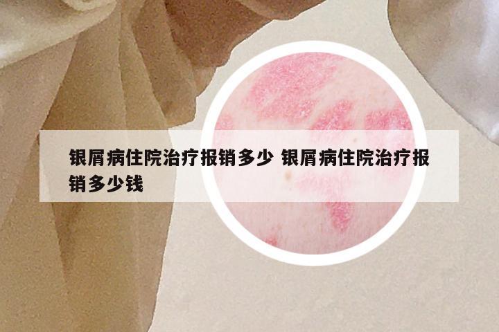 银屑病住院治疗报销多少 银屑病住院治疗报销多少钱