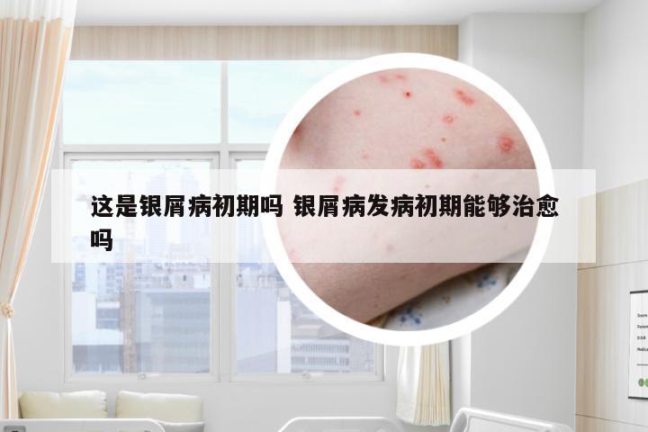 这是银屑病初期吗 银屑病发病初期能够治愈吗