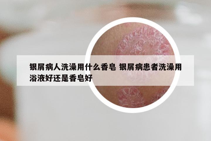 银屑病人洗澡用什么香皂 银屑病患者洗澡用浴液好还是香皂好