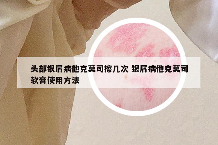 头部银屑病他克莫司擦几次 银屑病他克莫司软膏使用方法