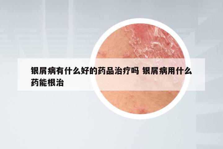 银屑病有什么好的药品治疗吗 银屑病用什么药能根治