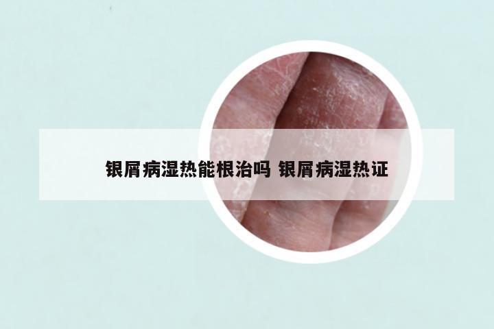 银屑病湿热能根治吗 银屑病湿热证