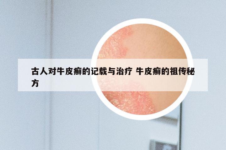 古人对牛皮癣的记载与治疗 牛皮癣的祖传秘方