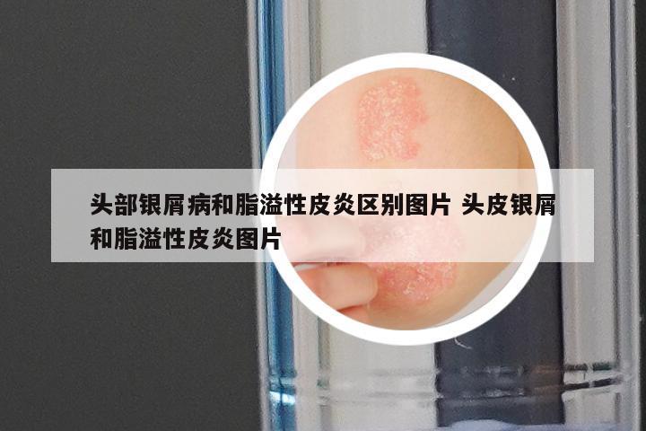 头部银屑病和脂溢性皮炎区别图片 头皮银屑和脂溢性皮炎图片