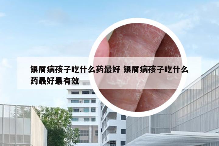 银屑病孩子吃什么药最好 银屑病孩子吃什么药最好最有效