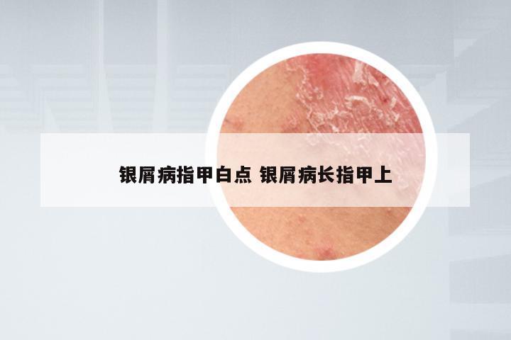 银屑病指甲白点 银屑病长指甲上