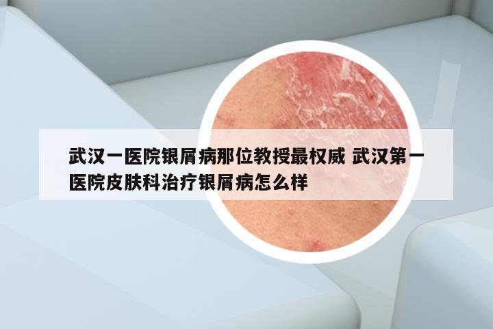 武汉一医院银屑病那位教授最权威 武汉第一医院皮肤科治疗银屑病怎么样