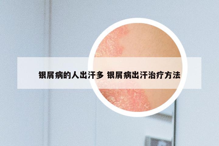 银屑病的人出汗多 银屑病出汗治疗方法