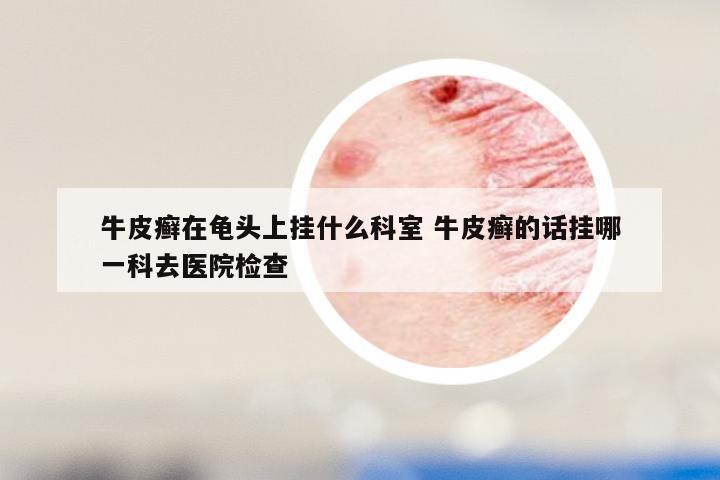 牛皮癣在龟头上挂什么科室 牛皮癣的话挂哪一科去医院检查