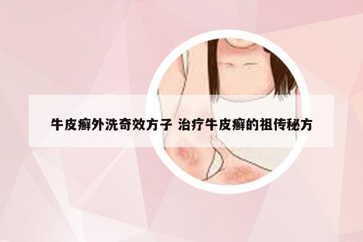 牛皮癣外洗奇效方子 治疗牛皮癣的祖传秘方
