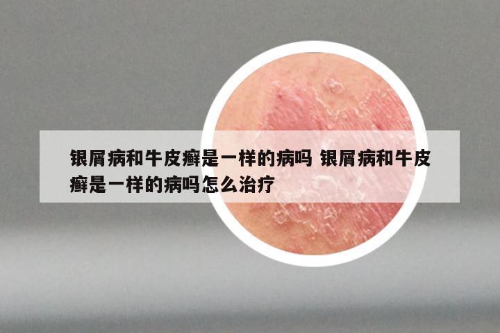 银屑病和牛皮癣是一样的病吗 银屑病和牛皮癣是一样的病吗怎么治疗