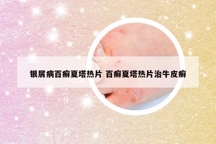 银屑病百癣夏塔热片 百癣夏塔热片治牛皮癣