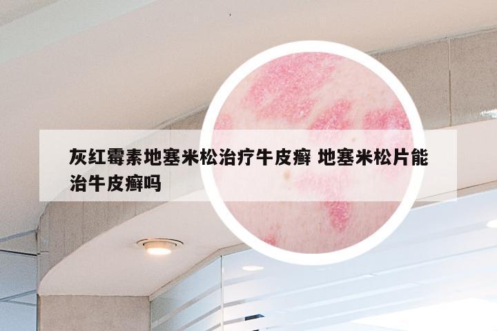 灰红霉素地塞米松治疗牛皮癣 地塞米松片能治牛皮癣吗
