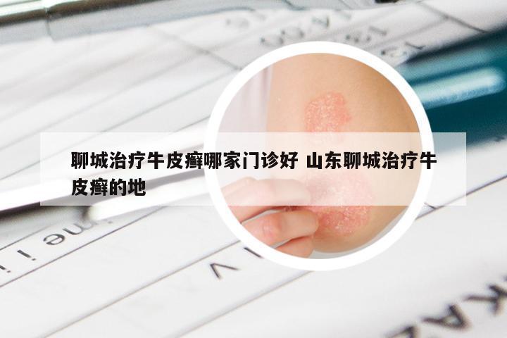 聊城治疗牛皮癣哪家门诊好 山东聊城治疗牛皮癣的地