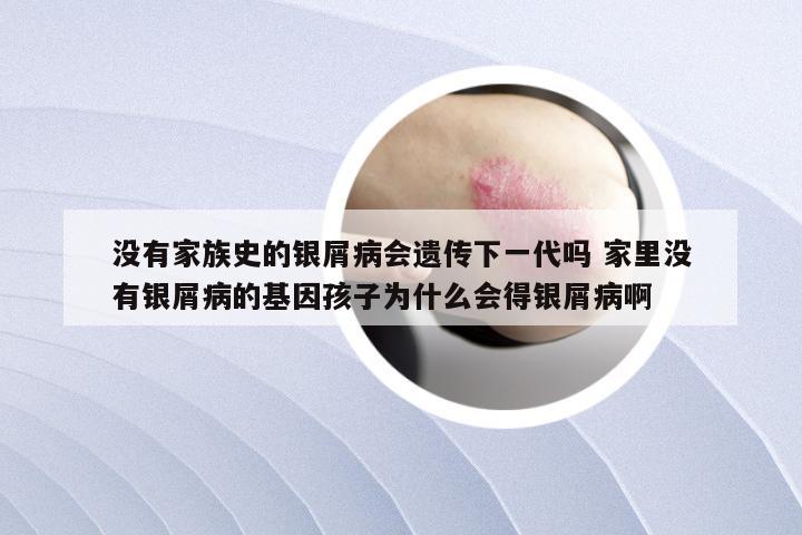 没有家族史的银屑病会遗传下一代吗 家里没有银屑病的基因孩子为什么会得银屑病啊