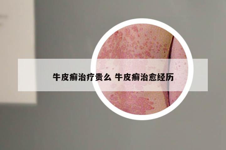 牛皮癣治疗贵么 牛皮癣治愈经历