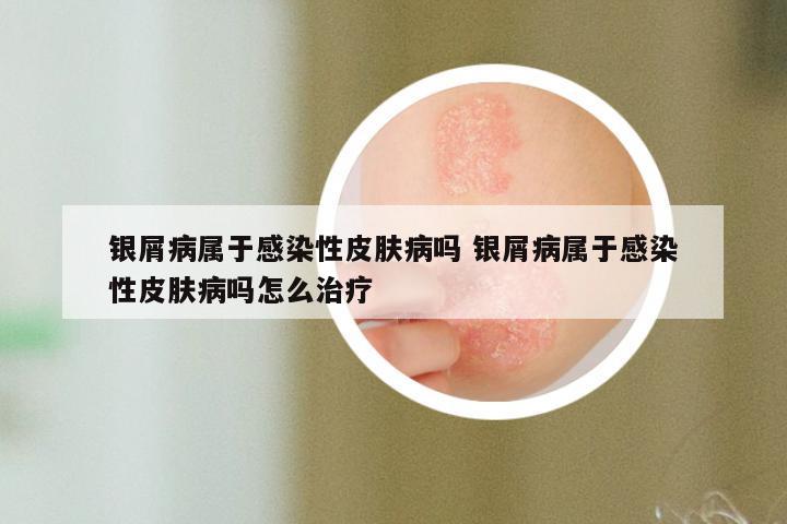 银屑病属于感染性皮肤病吗 银屑病属于感染性皮肤病吗怎么治疗