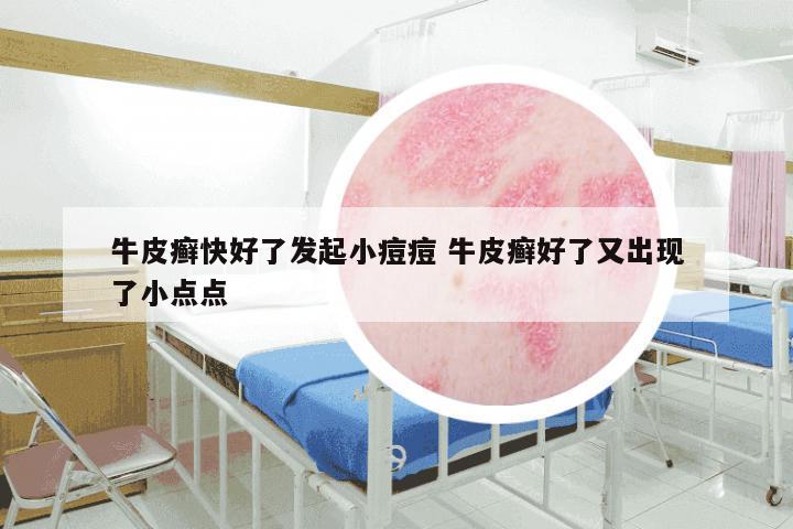 牛皮癣快好了发起小痘痘 牛皮癣好了又出现了小点点