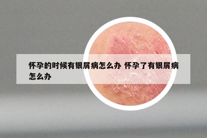 怀孕的时候有银屑病怎么办 怀孕了有银屑病怎么办
