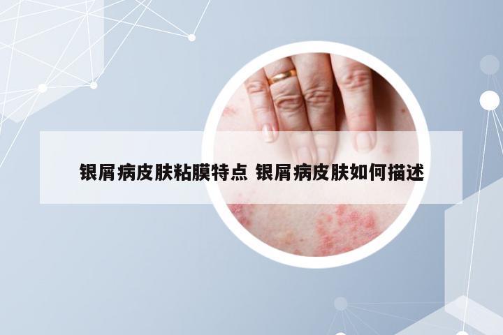 银屑病皮肤粘膜特点 银屑病皮肤如何描述