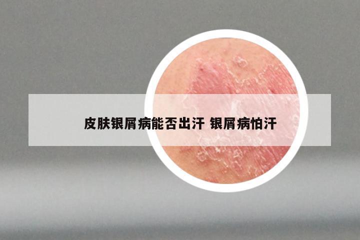 皮肤银屑病能否出汗 银屑病怕汗