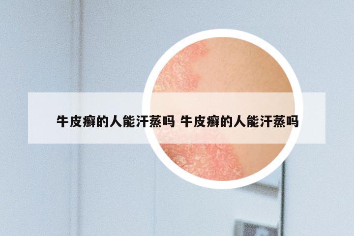 牛皮癣的人能汗蒸吗 牛皮癣的人能汗蒸吗