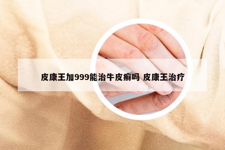 皮康王加999能治牛皮癣吗 皮康王治疗