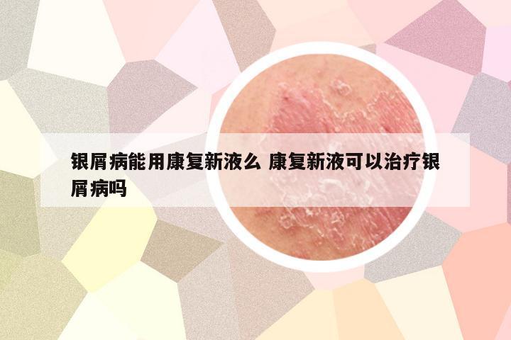 银屑病能用康复新液么 康复新液可以治疗银屑病吗