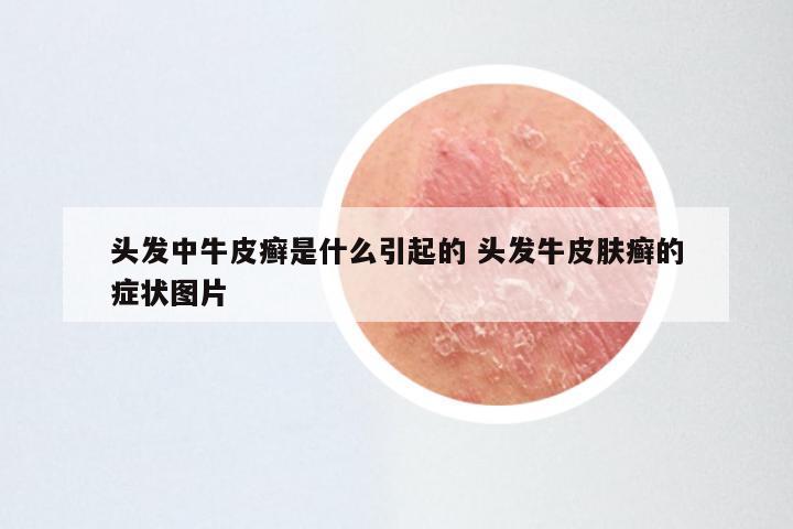 头发中牛皮癣是什么引起的 头发牛皮肤癣的症状图片