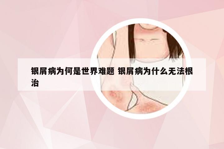 银屑病为何是世界难题 银屑病为什么无法根治
