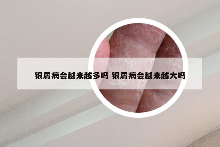 银屑病会越来越多吗 银屑病会越来越大吗