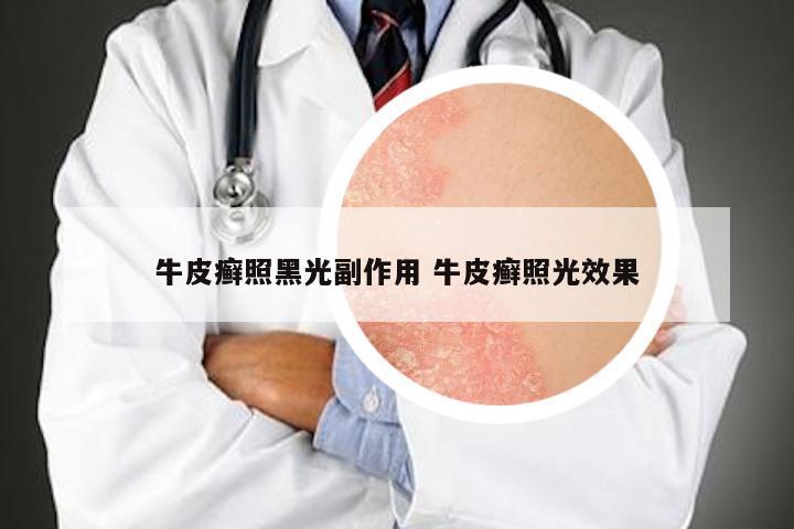 牛皮癣照黑光副作用 牛皮癣照光效果