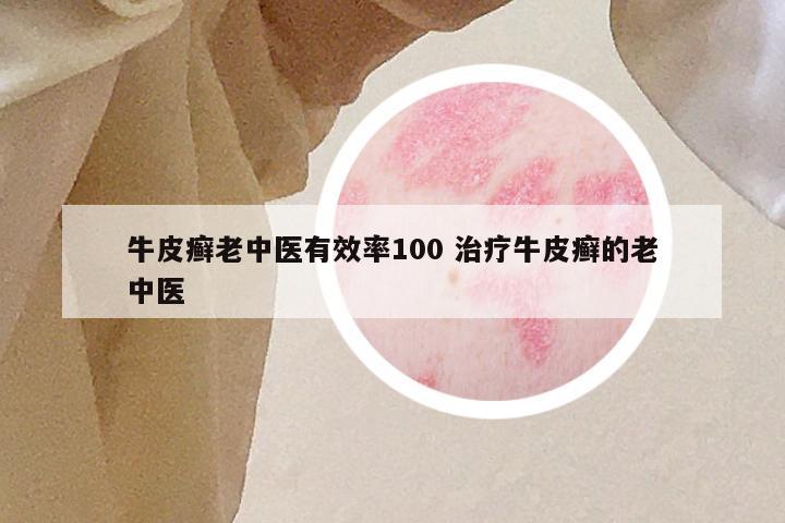 牛皮癣老中医有效率100 治疗牛皮癣的老中医