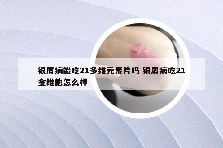 银屑病能吃21多维元素片吗 银屑病吃21金维他怎么样