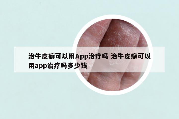 治牛皮癣可以用App治疗吗 治牛皮癣可以用app治疗吗多少钱