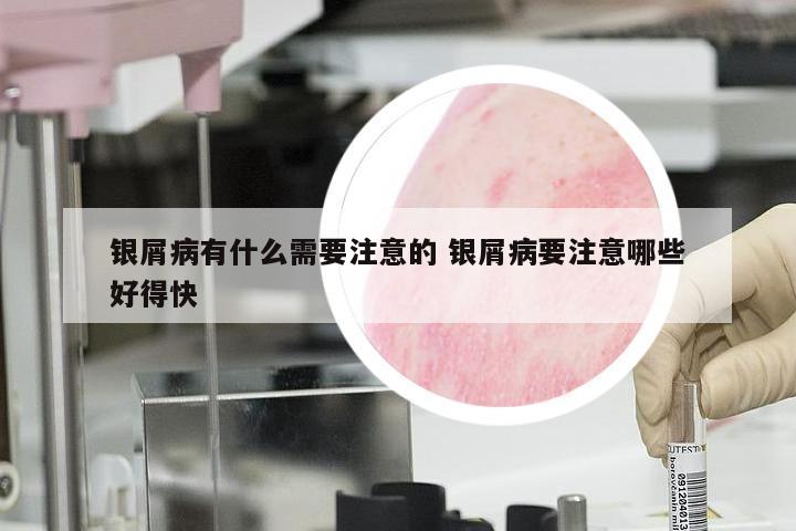 银屑病有什么需要注意的 银屑病要注意哪些好得快
