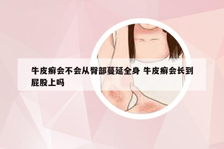 牛皮癣会不会从臀部蔓延全身 牛皮癣会长到屁股上吗