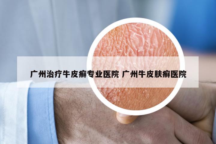 广州治疗牛皮癣专业医院 广州牛皮肤癣医院