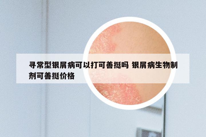 寻常型银屑病可以打可善挺吗 银屑病生物制剂可善挺价格