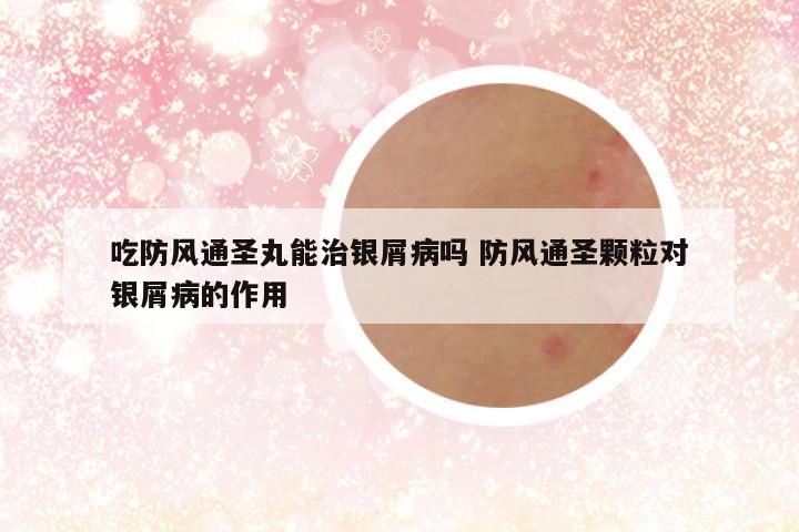 吃防风通圣丸能治银屑病吗 防风通圣颗粒对银屑病的作用