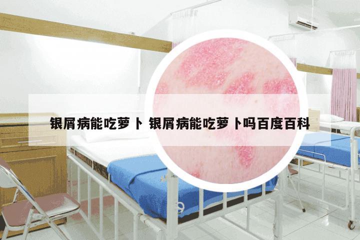 银屑病能吃萝卜 银屑病能吃萝卜吗百度百科