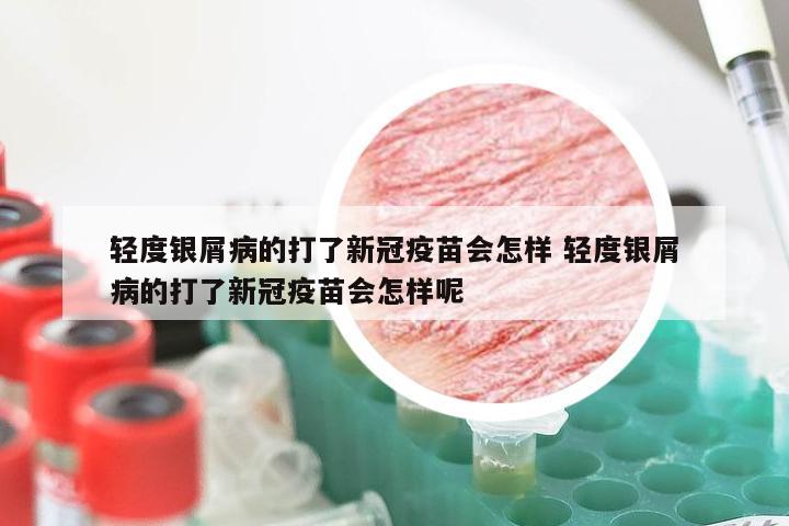 轻度银屑病的打了新冠疫苗会怎样 轻度银屑病的打了新冠疫苗会怎样呢
