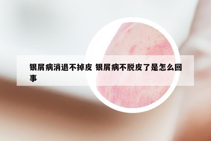 银屑病消退不掉皮 银屑病不脱皮了是怎么回事