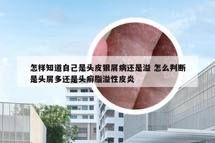 怎样知道自己是头皮银屑病还是溢 怎么判断是头屑多还是头癣脂溢性皮炎