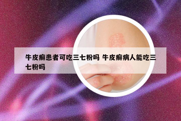 牛皮癣患者可吃三七粉吗 牛皮癣病人能吃三七粉吗